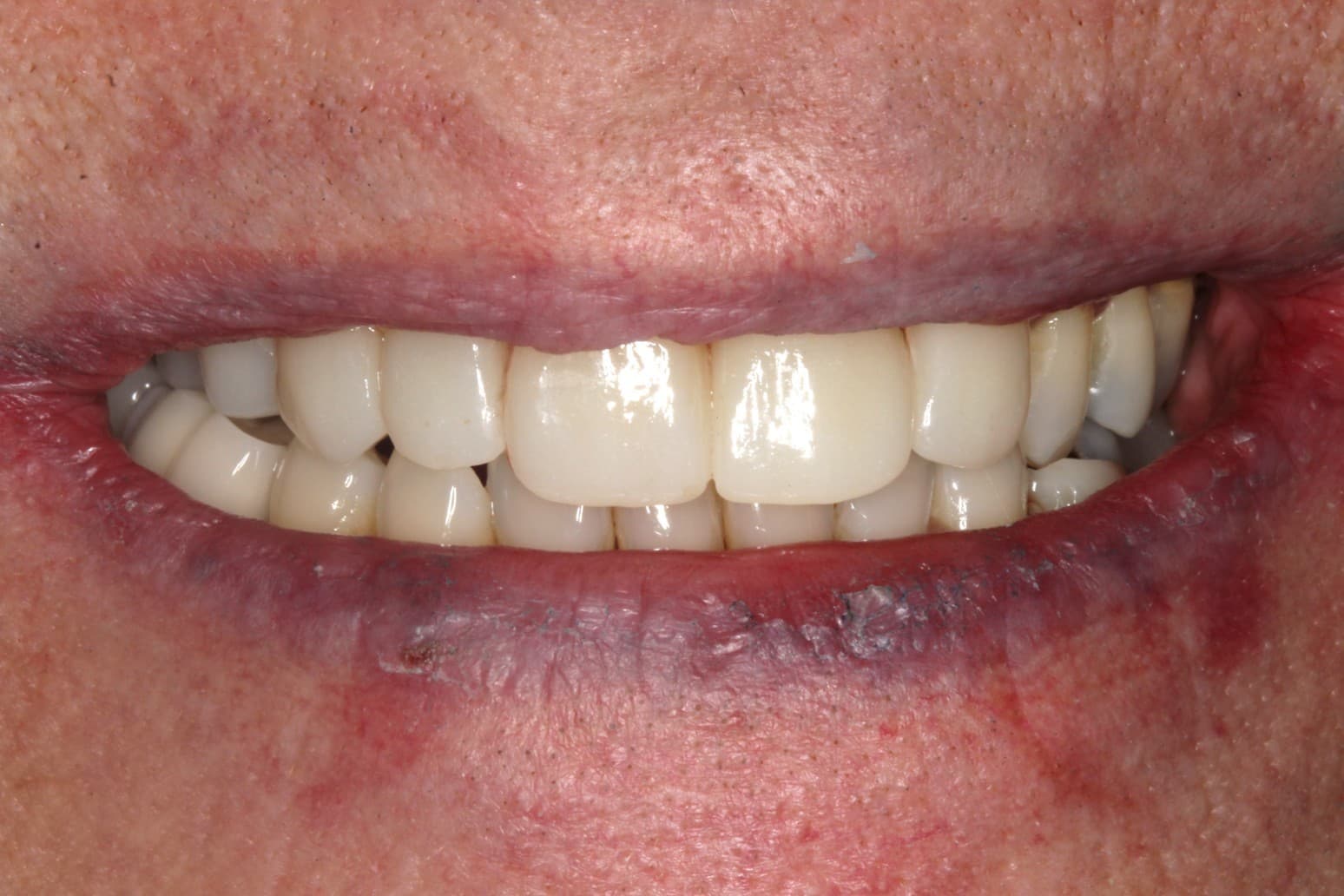 After dental bridge treatment