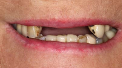 Before dental bridge treatment