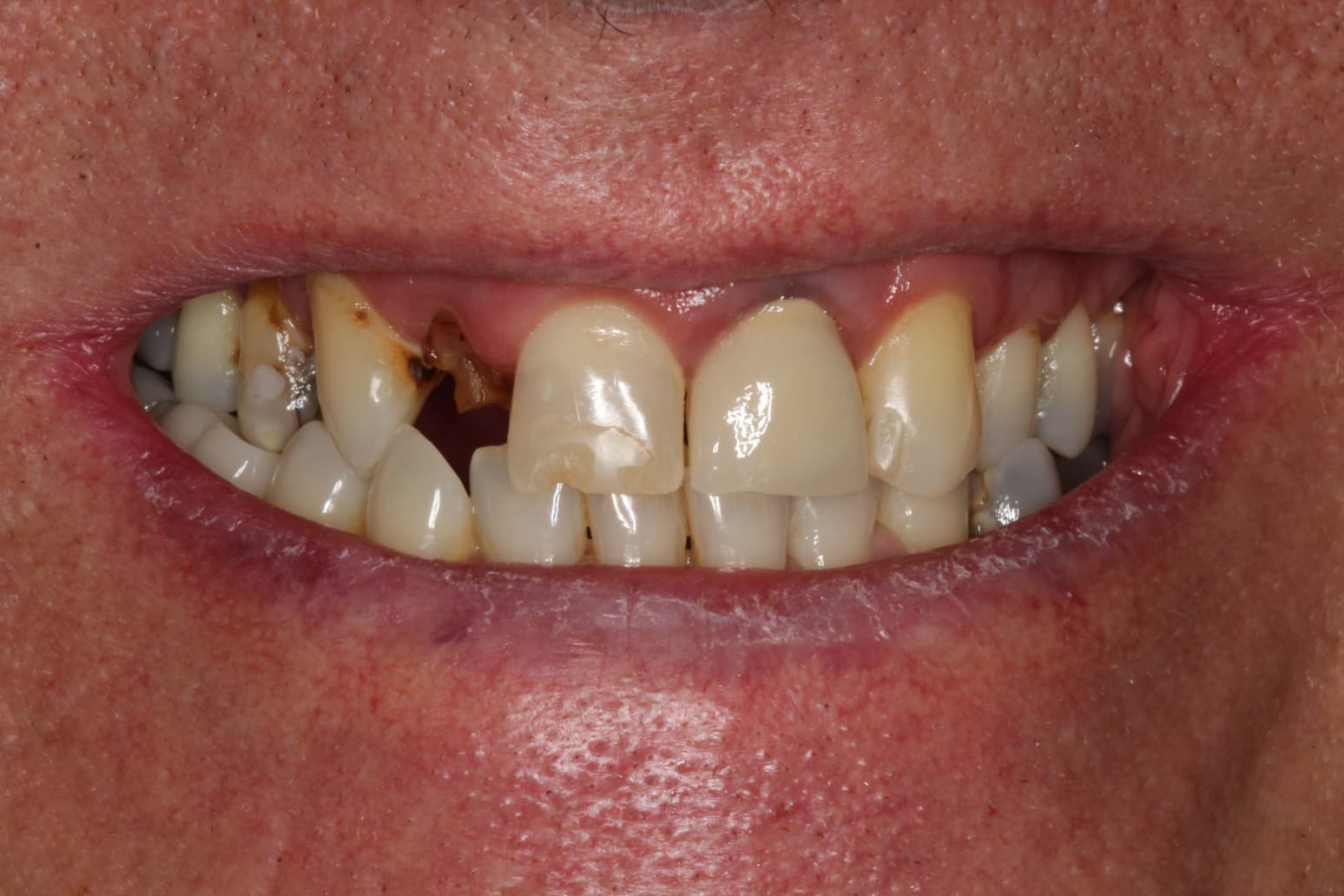 Before dental bridge treatment