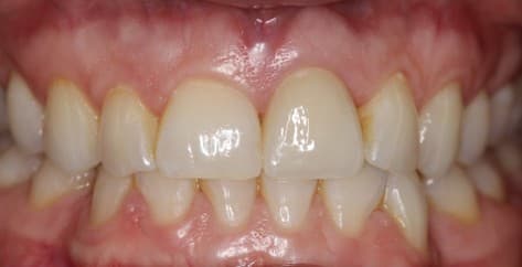 After ceramic crown treatment