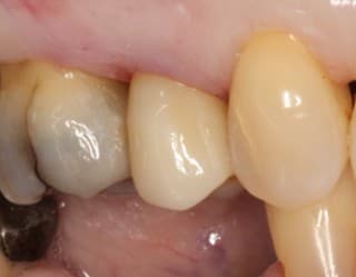 After ceramic crown treatment