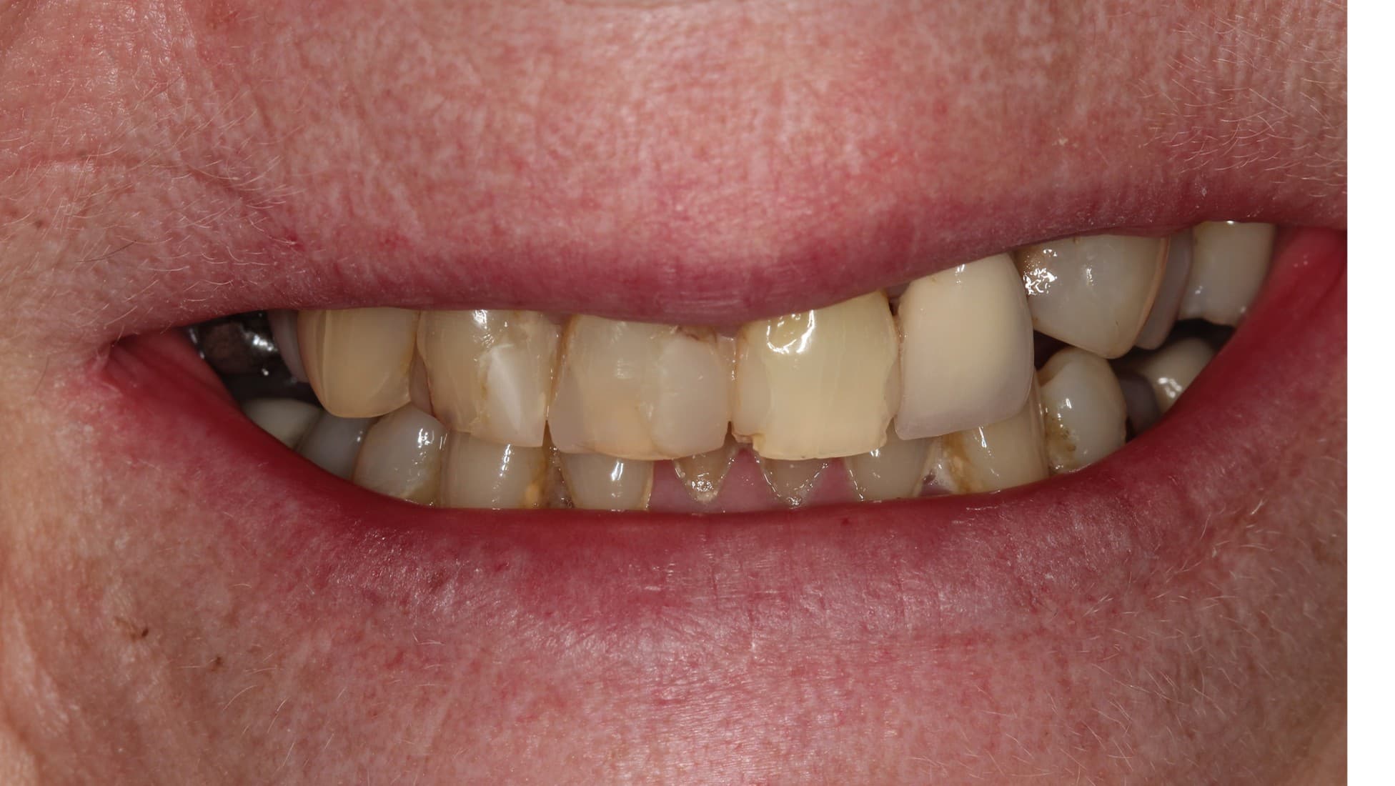 Before ceramic restoration treatment