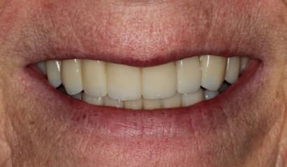 After ceramic restoration treatment