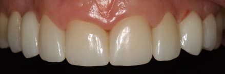 After ceramic restoration treatment