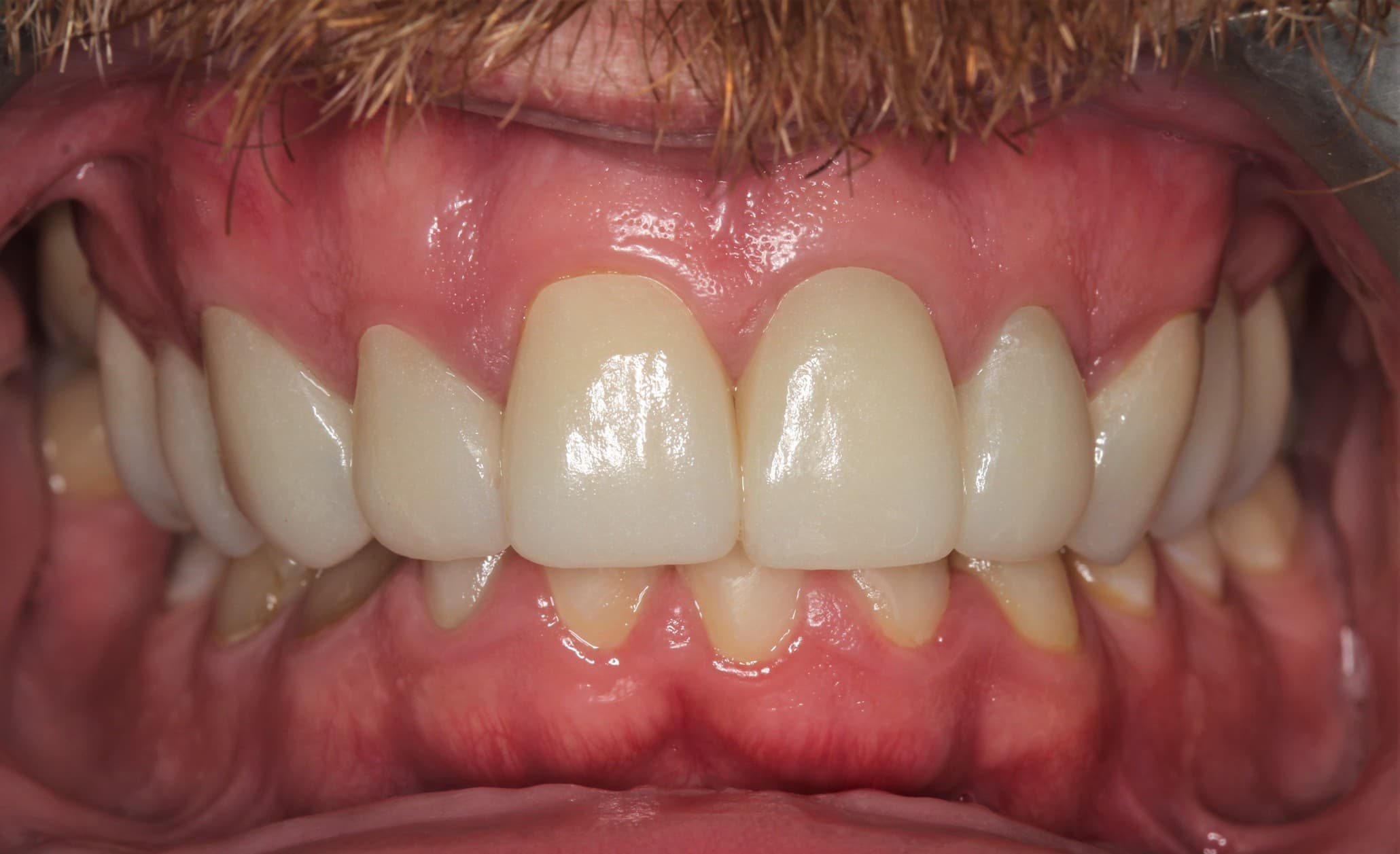 After ceramic restoration treatment