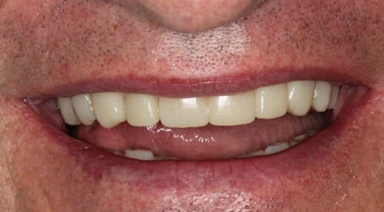 After ceramic restoration treatment