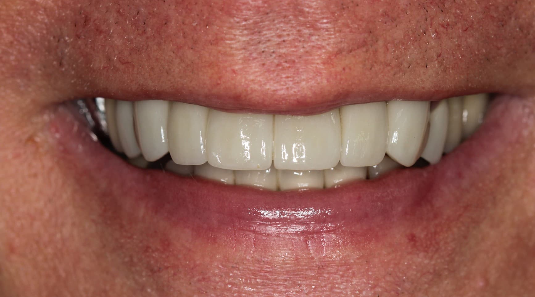 After ceramic restoration treatment