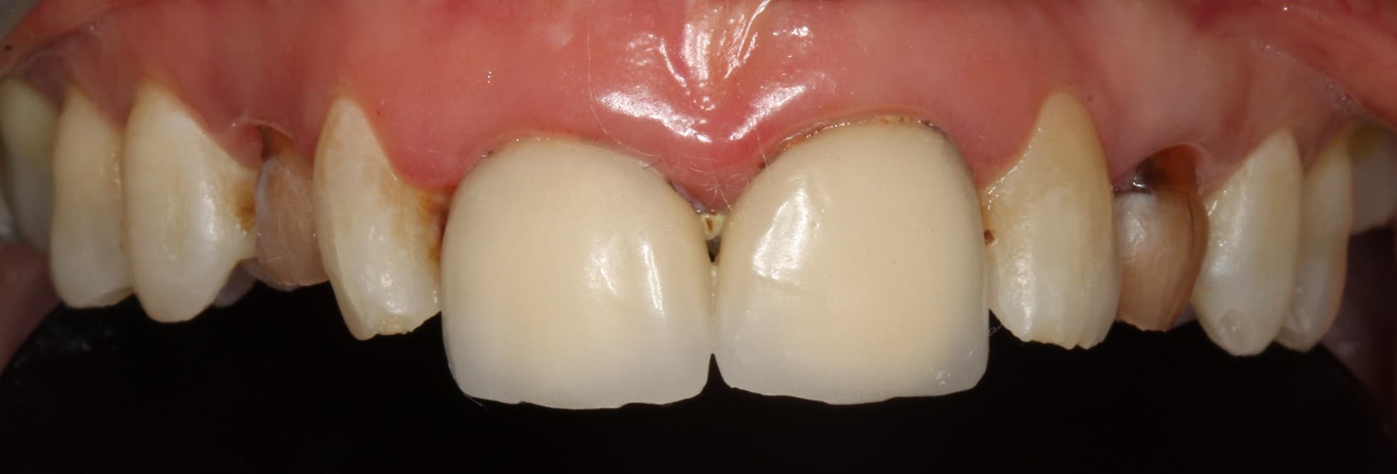 Before ceramic restoration treatment