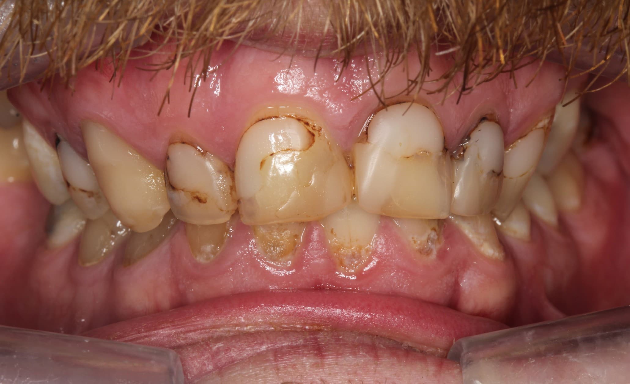 Before ceramic restoration treatment