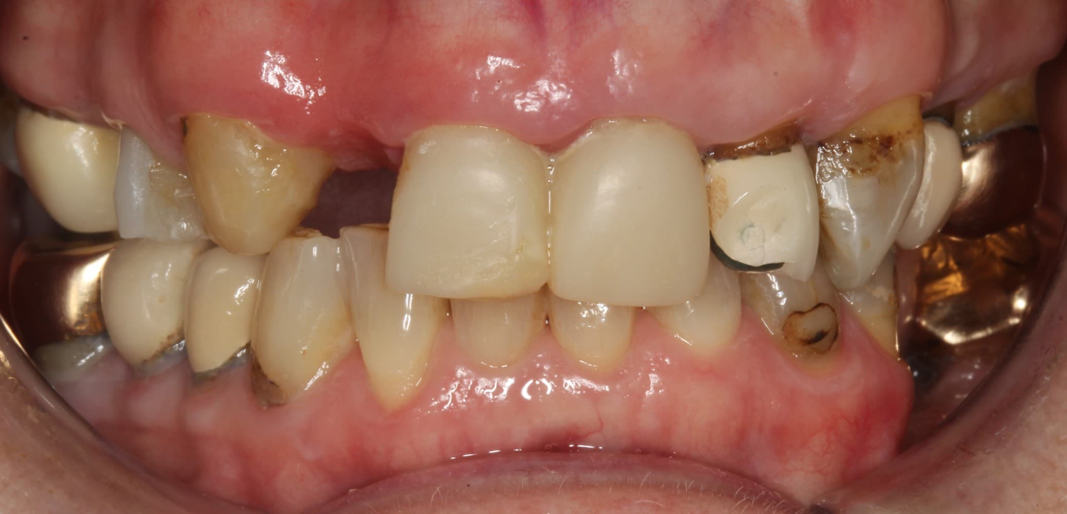 Before ceramic restoration treatment