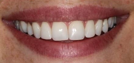 After composite bonding treatment