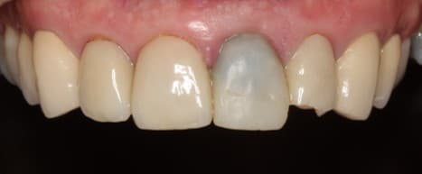 Before ceramic restoration treatment