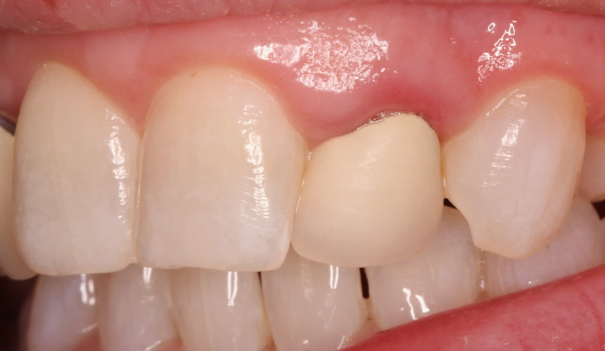 Before crown lengthening treatment