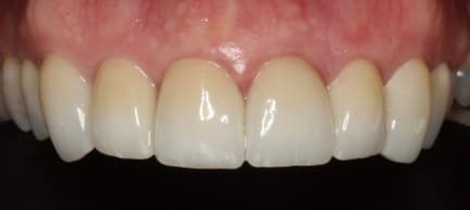 After ceramic restoration treatment