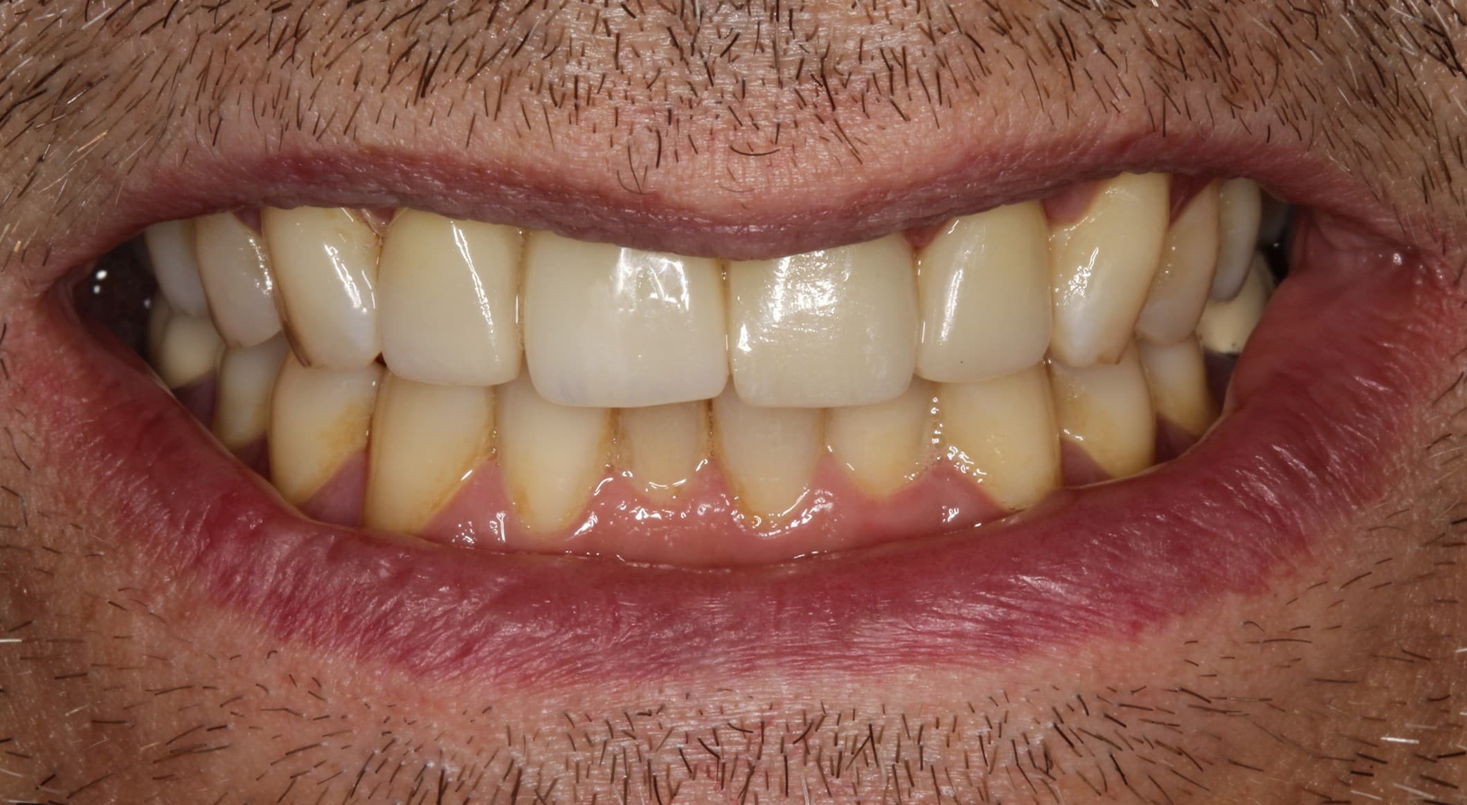 After dental implants treatment