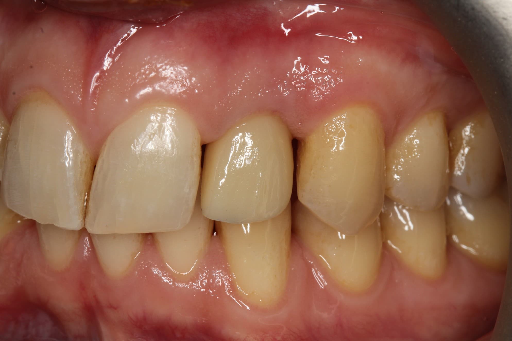 After dental implants treatment