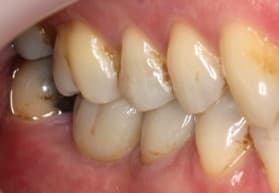 After dental implants treatment