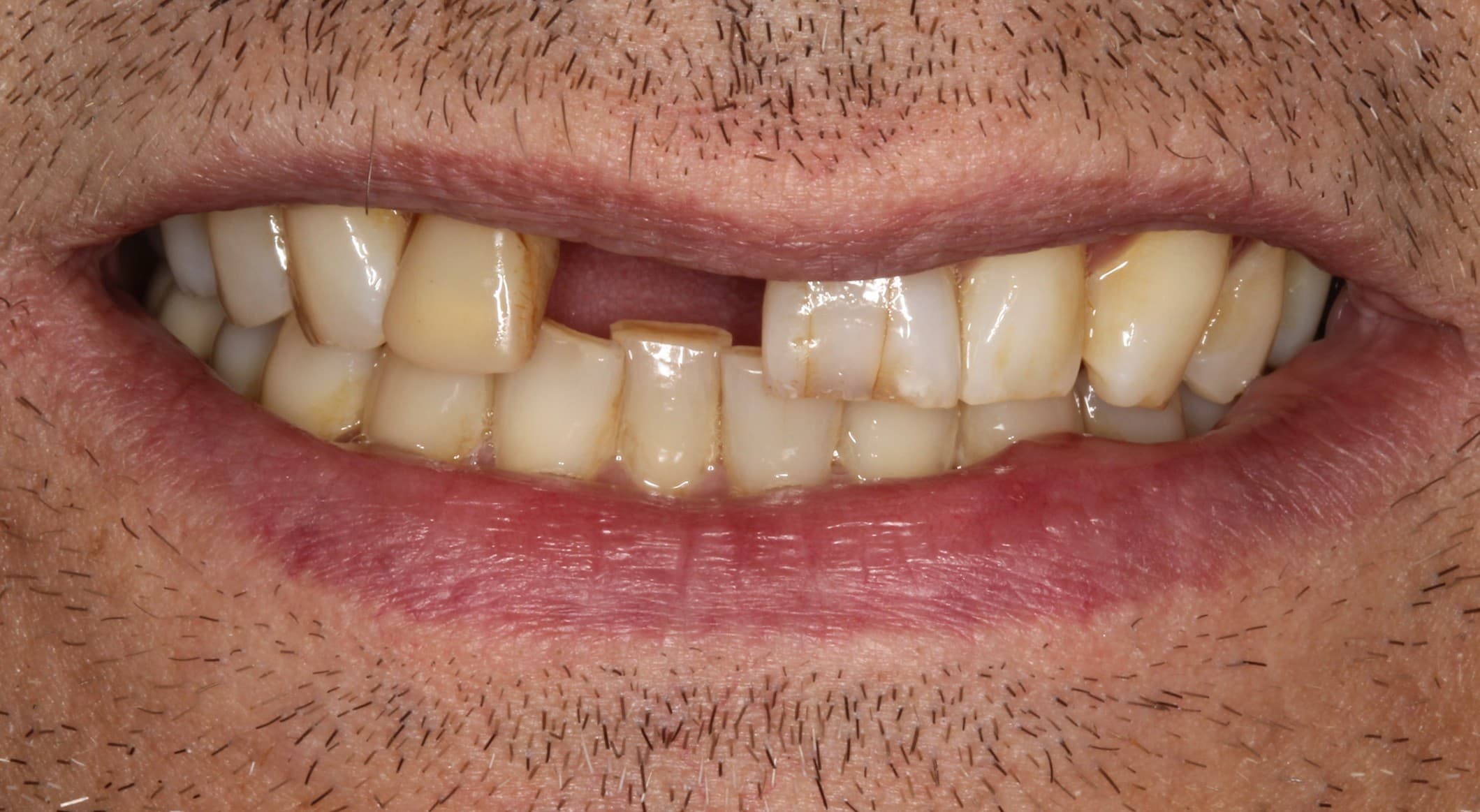 Before dental implants treatment