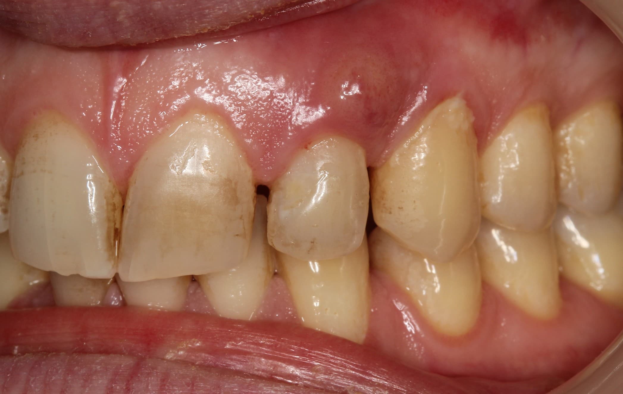 Before dental implants treatment