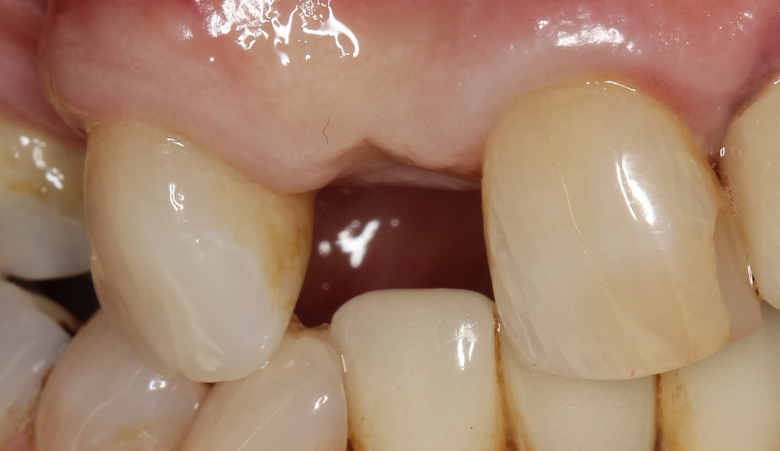Before dental implants treatment