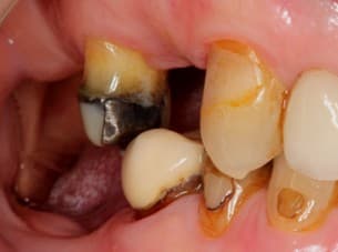 Before dental implants treatment