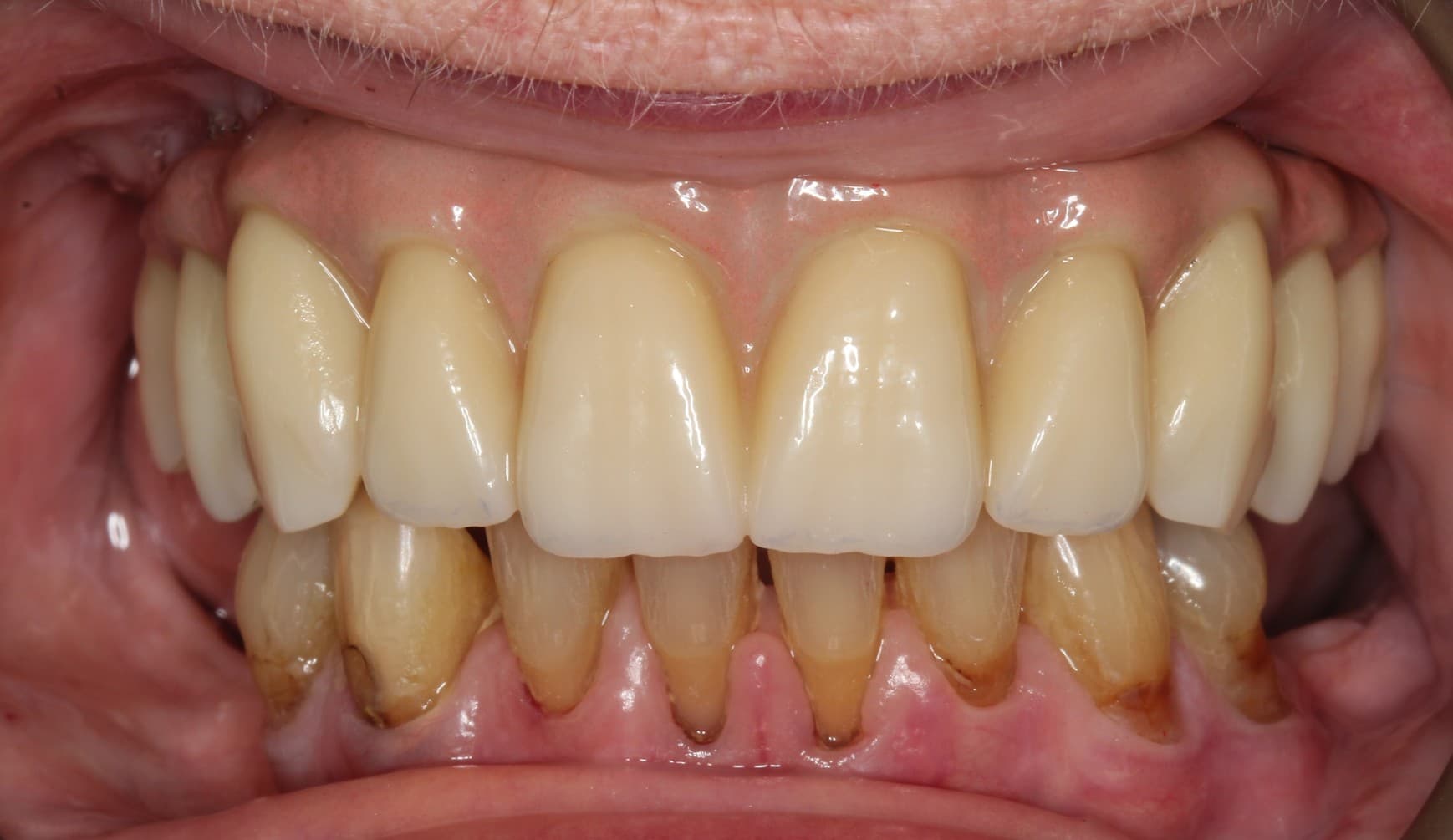 After full-mouth implants treatment