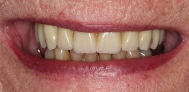 After full-mouth implants treatment