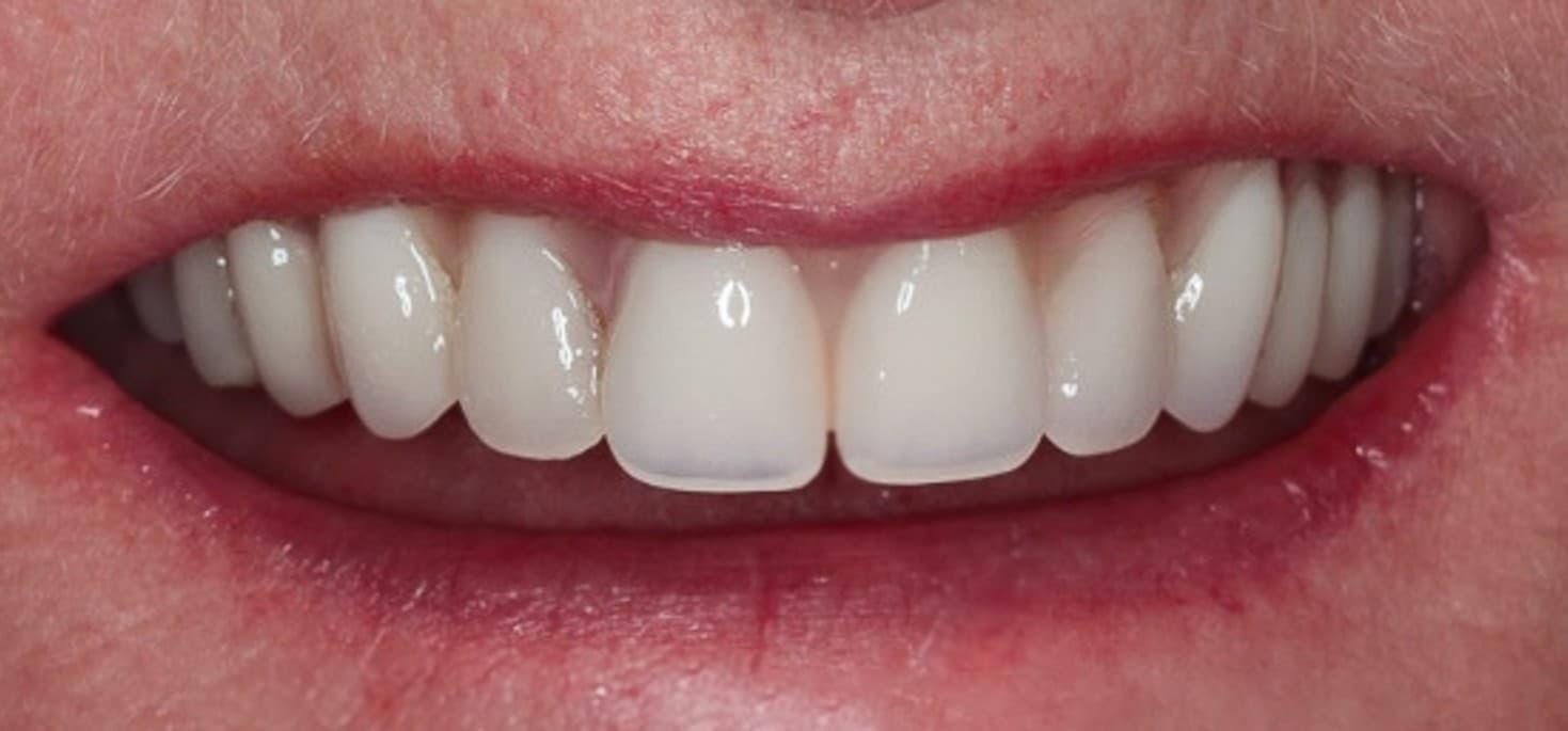 After full-mouth implants treatment