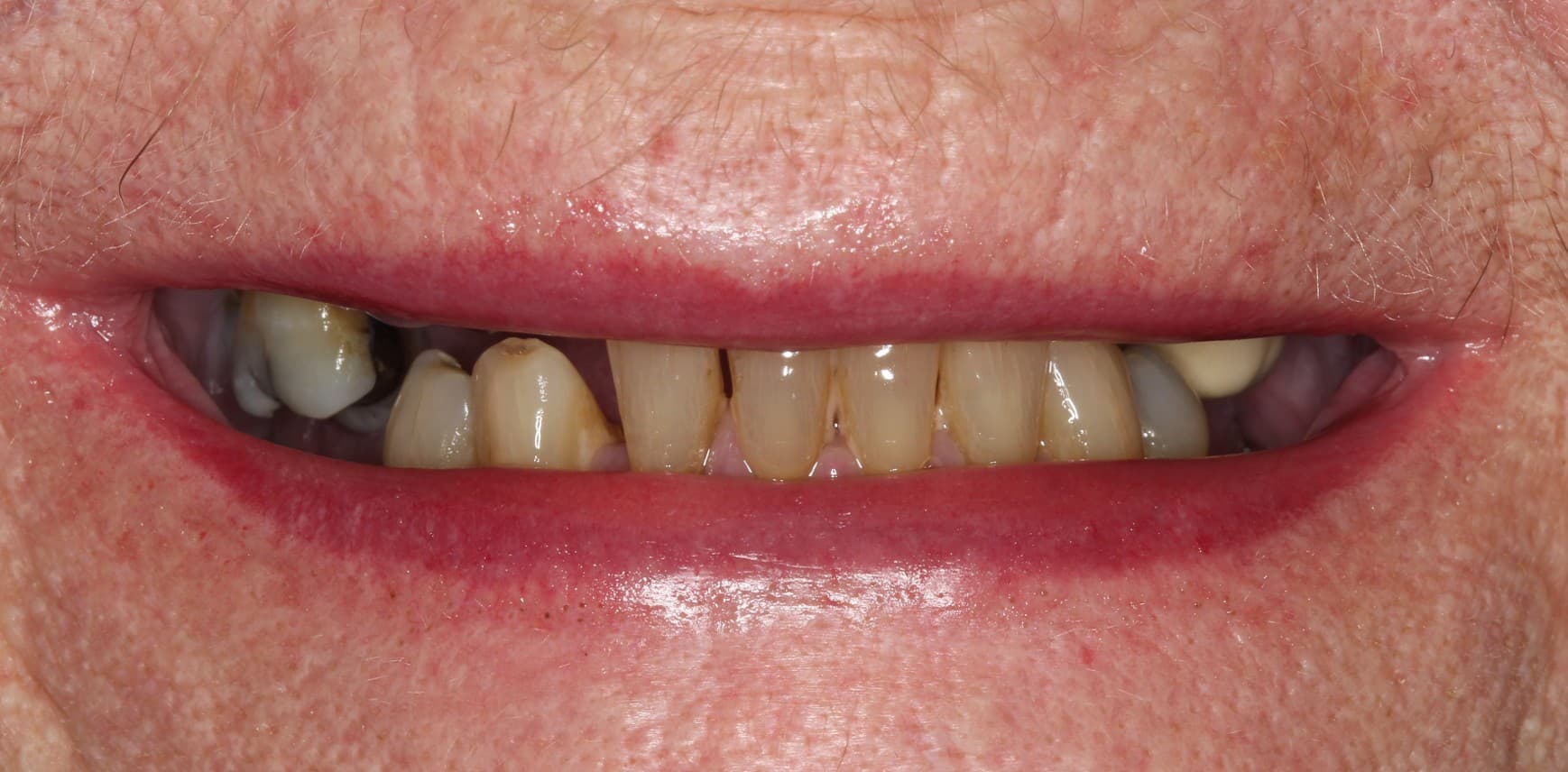Before full-mouth implants treatment