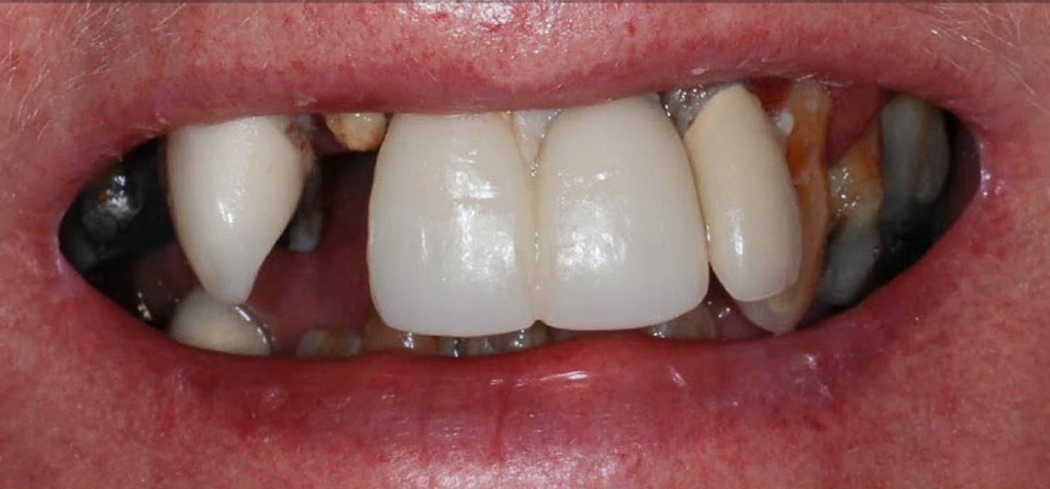 Before full-mouth implants treatment
