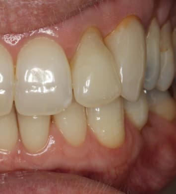 After internal bleaching treatment