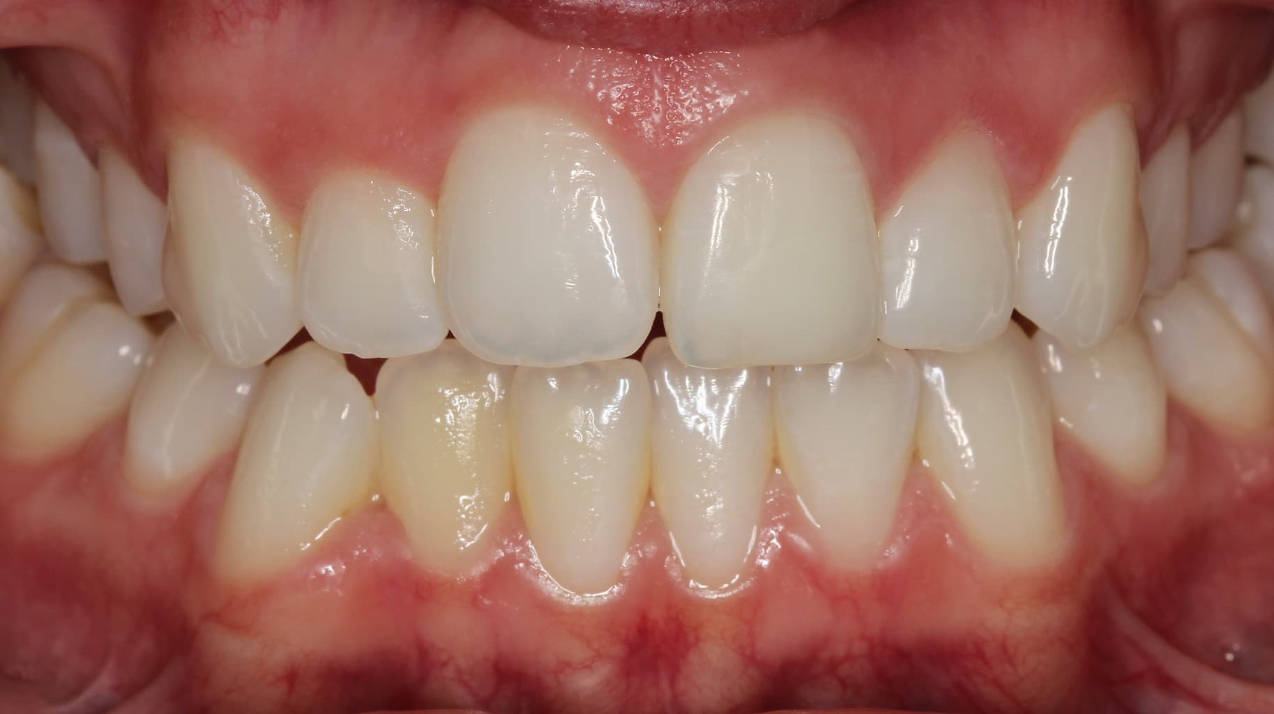 After internal bleaching treatment