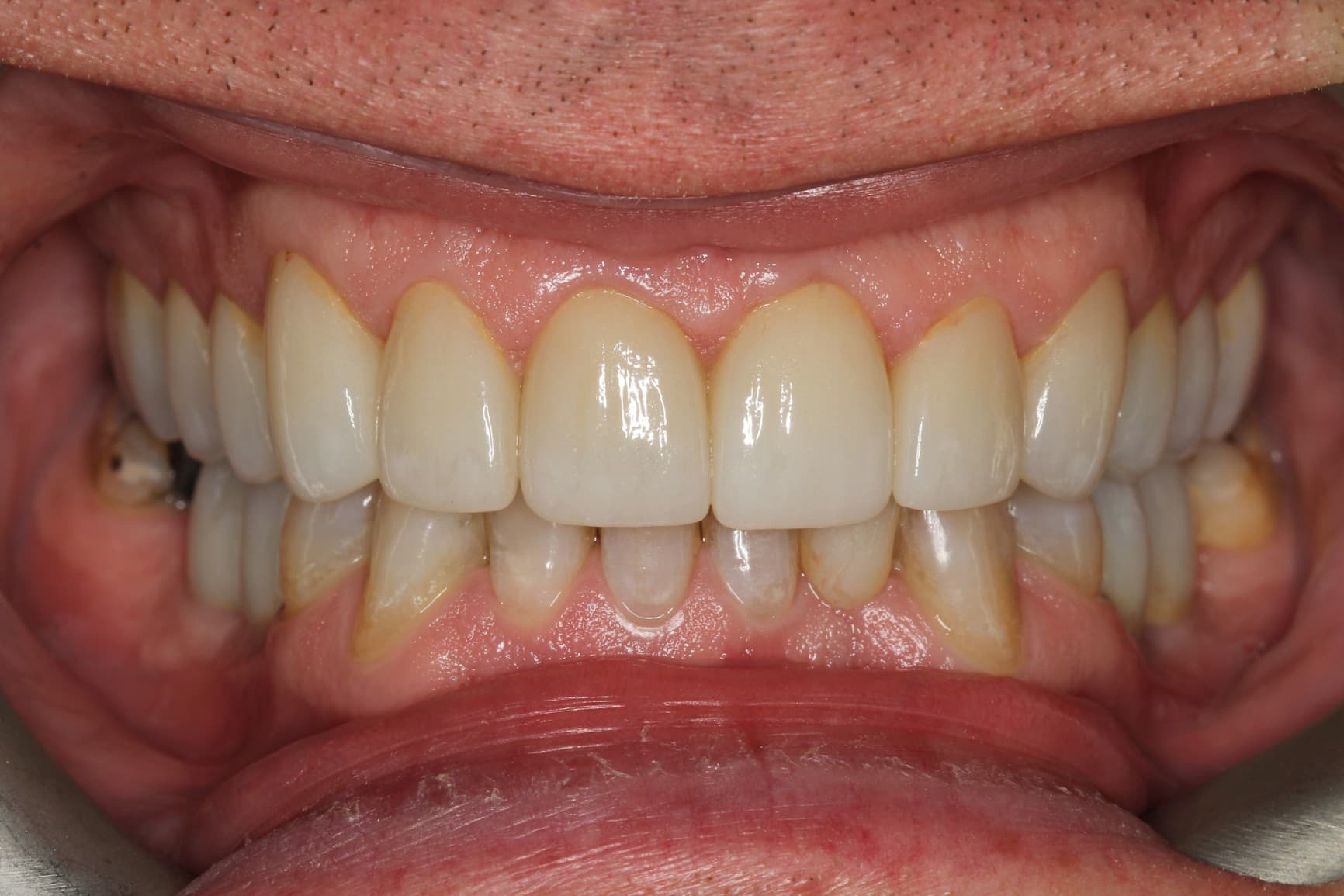 After ceramic restoration treatment