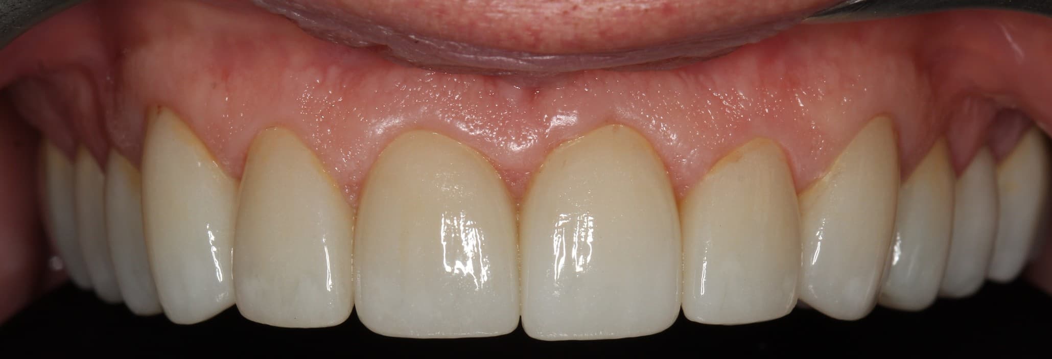After no drilling 3d veneers treatment