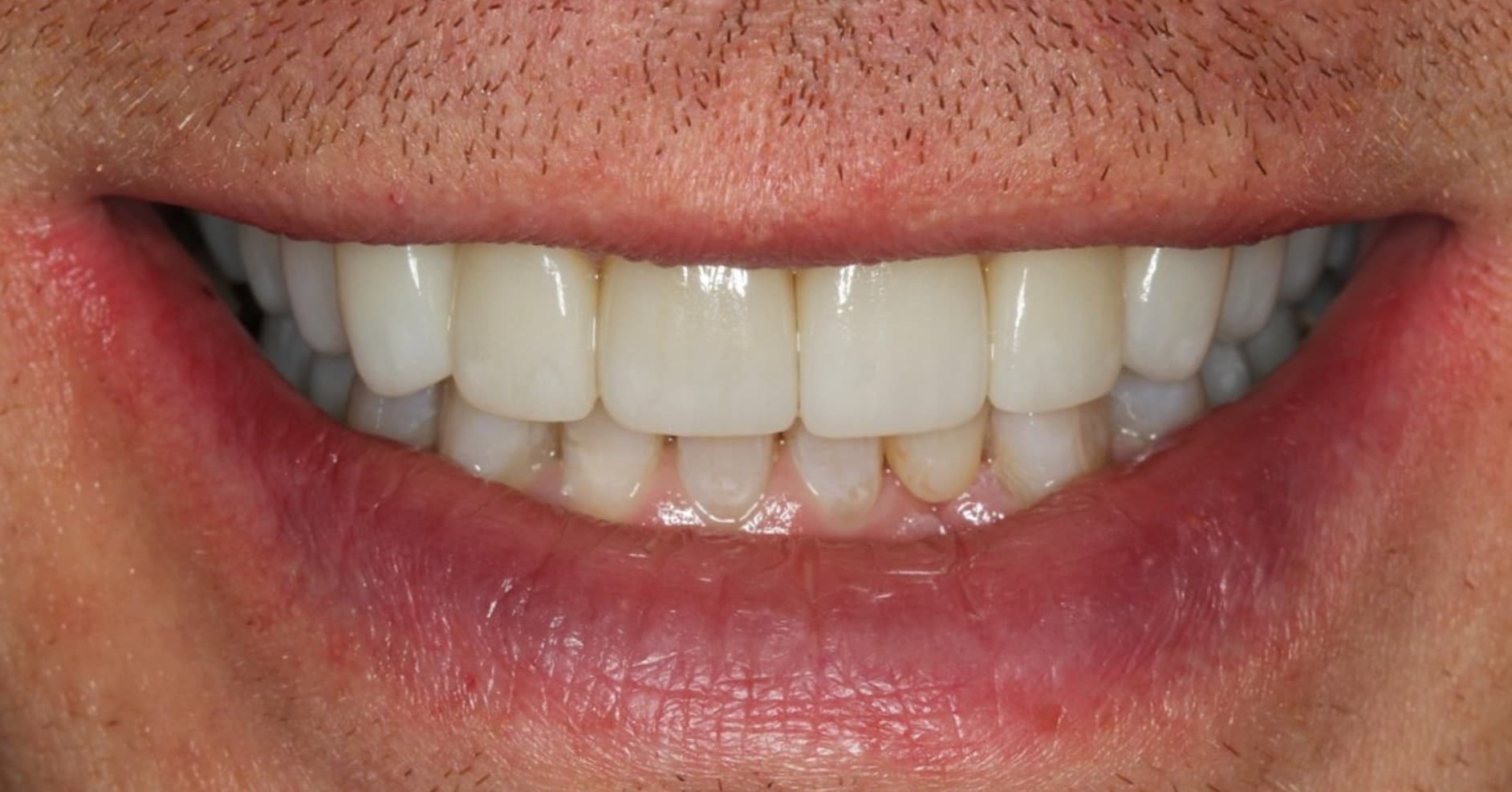 After ceramic restoration treatment