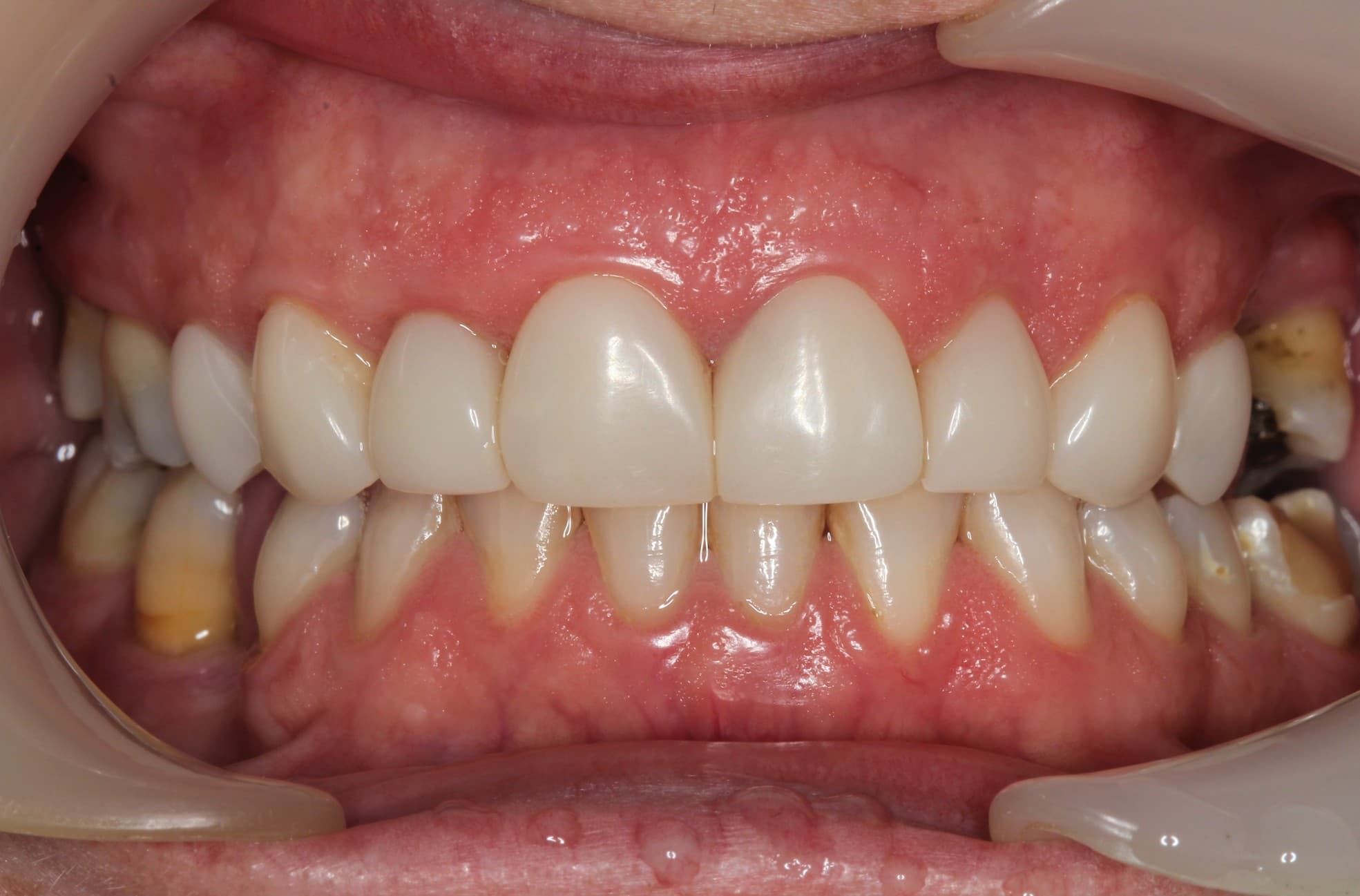 After no drilling 3d veneers treatment