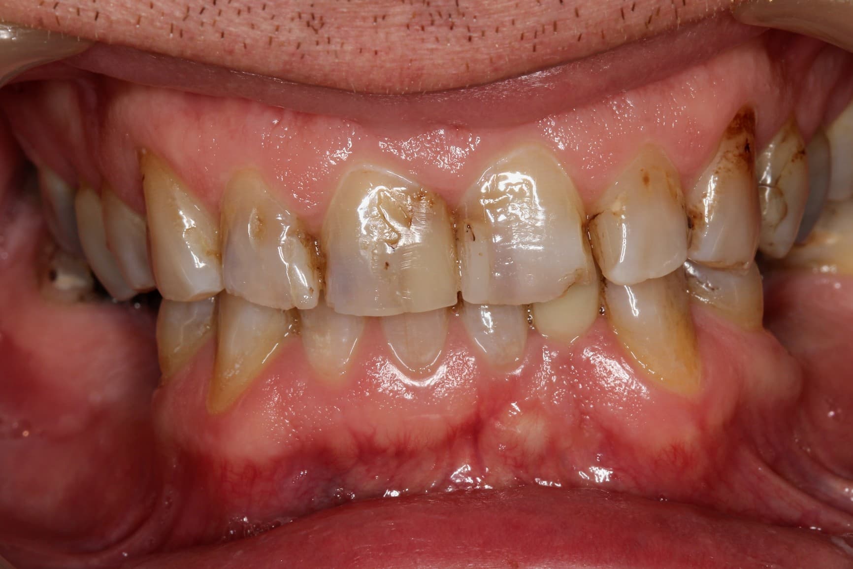 Before ceramic restoration treatment