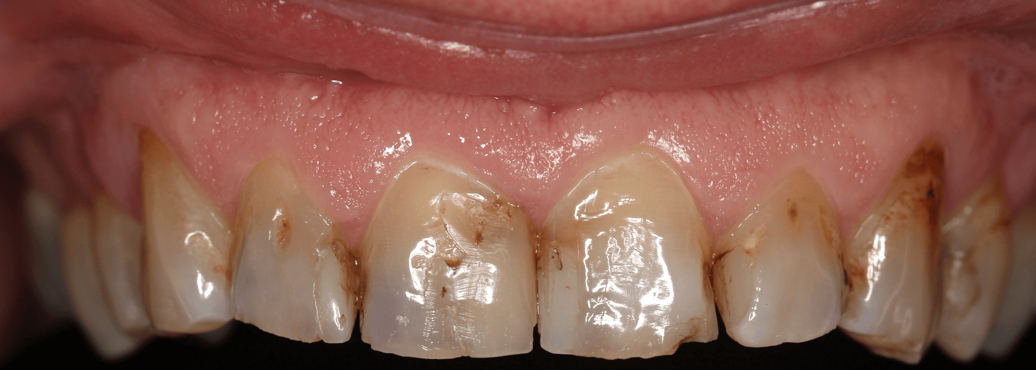 Before no drilling 3d veneers treatment