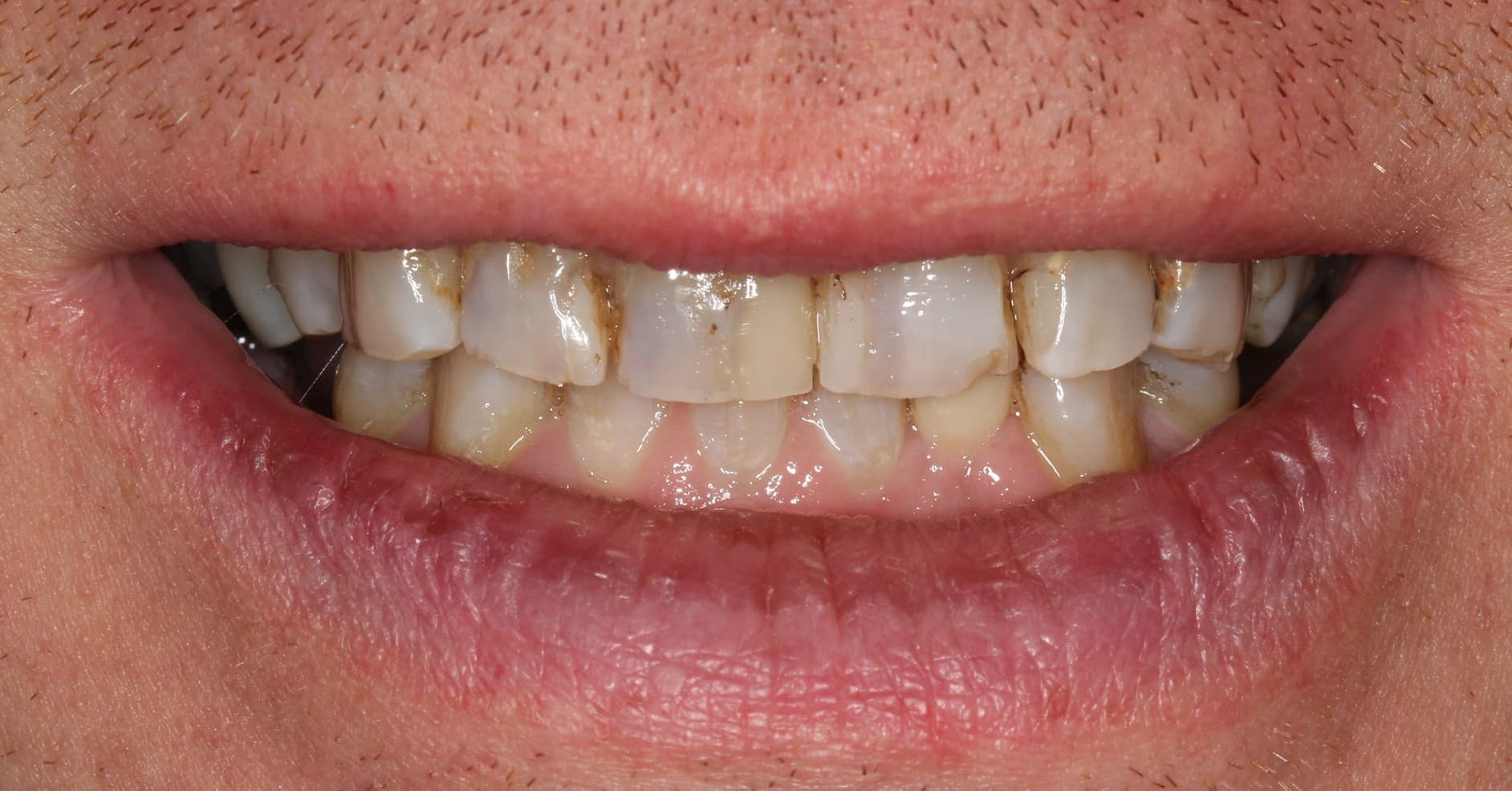 Before ceramic restoration treatment