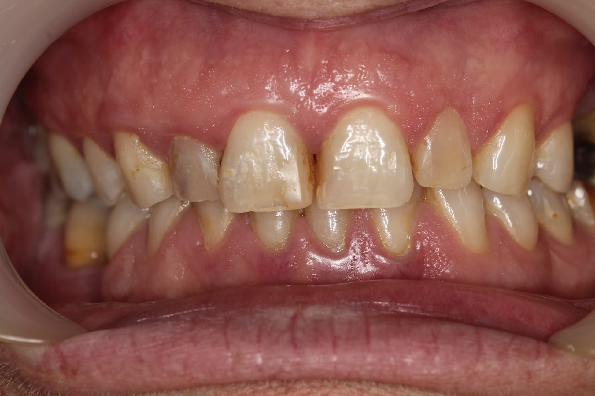 Before no drilling 3d veneers treatment