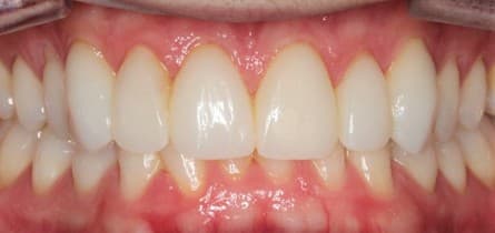 After porcelain veneers treatment